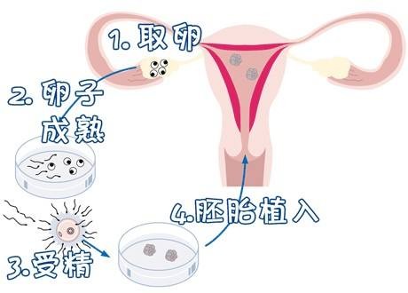 试管代怀生子助孕代妈